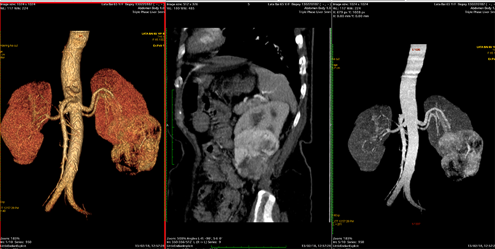 radiant dicom viewer cracked rib